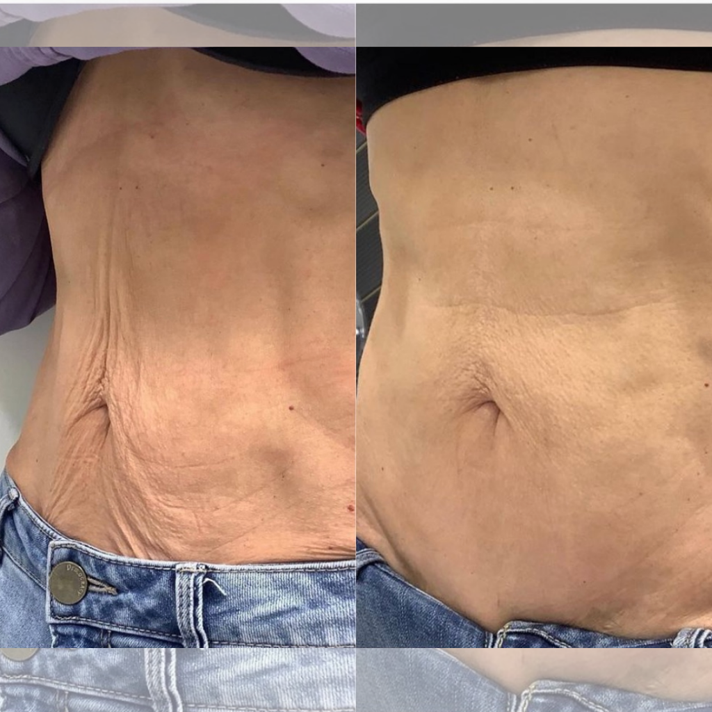 VIBRAPRO - Appareil Anti-Cellulite & Brûle-Graisse