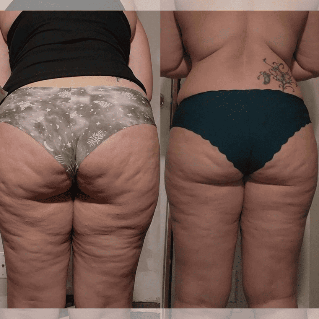VIBRAPRO - Appareil Anti-Cellulite & Brûle-Graisse