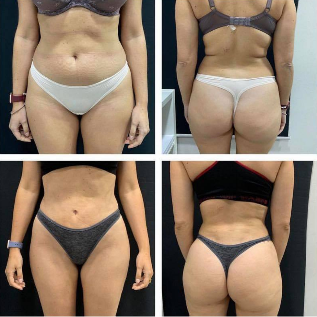 VIBRAPRO - Appareil Anti-Cellulite & Brûle-Graisse