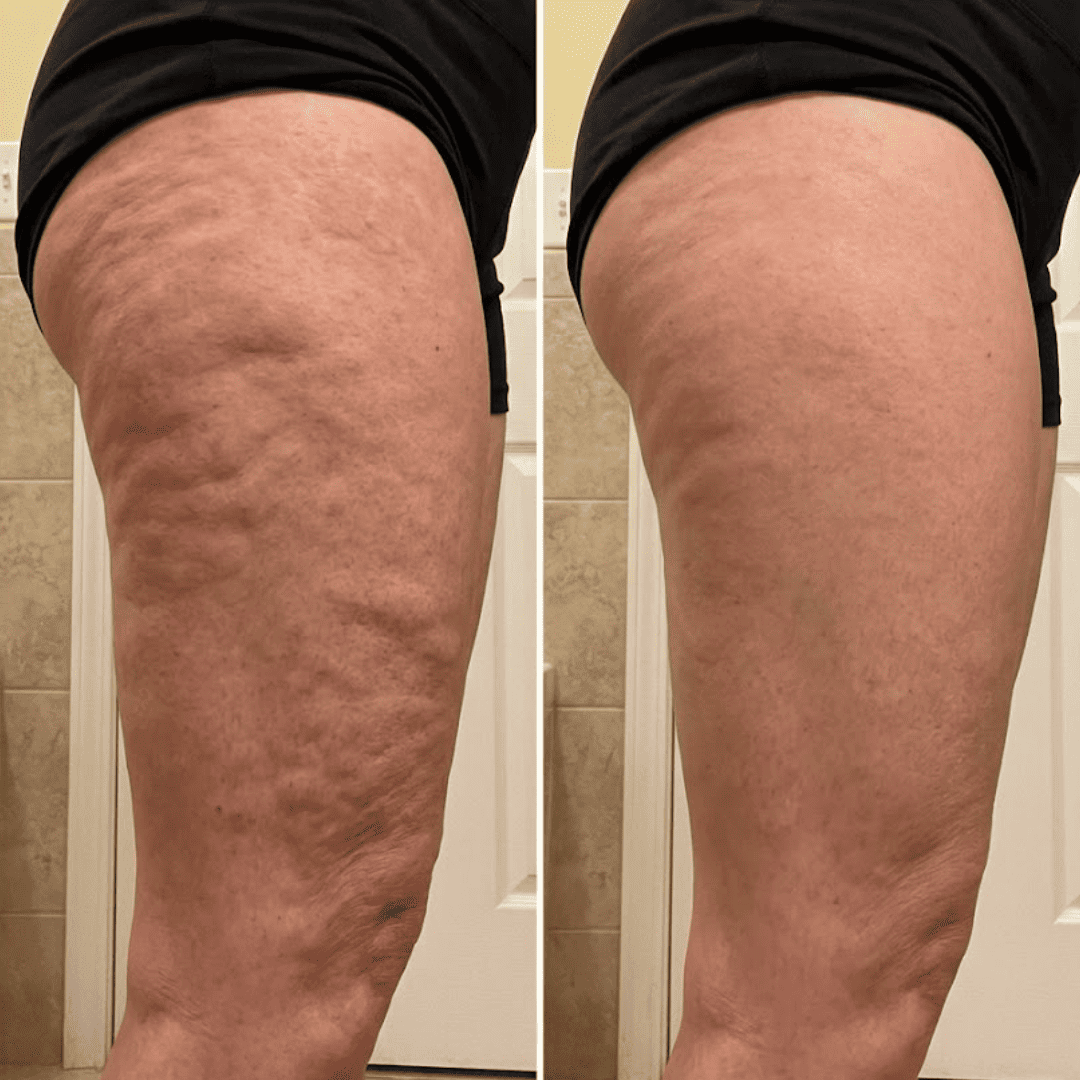VIBRAPRO - Appareil Anti-Cellulite & Brûle-Graisse